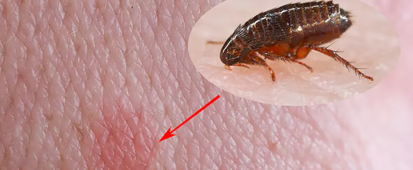 Flea Control for Humans Torrance, CA